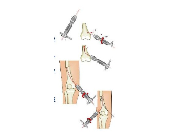 上海開為Carefix兒童骨折彈性髓內(nèi)針固定