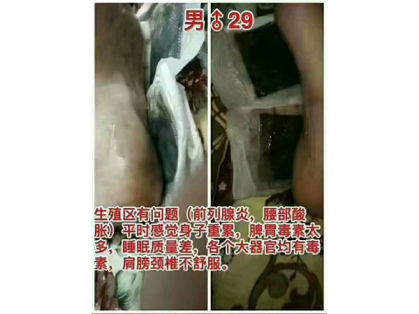 大今美穴位貼敷治療貼