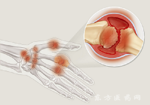 風(fēng)濕類風(fēng)濕1