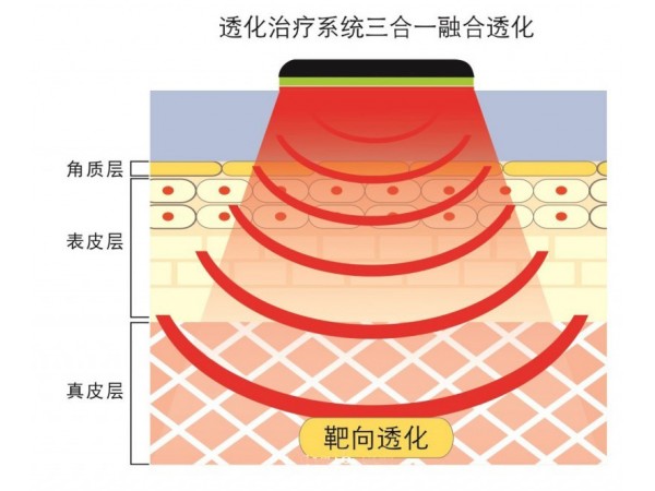 透化治療系統(tǒng)