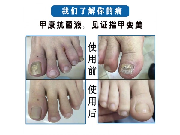 溢美甲康抗菌液