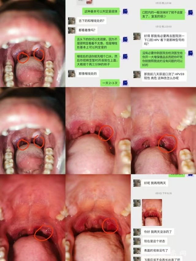 HPV人乳頭瘤病毒尖銳濕疣