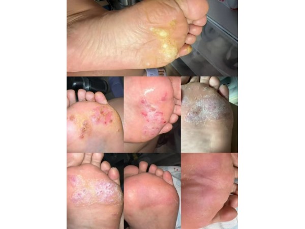 HPV人乳頭瘤病毒尖銳濕疣