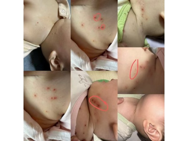 HPV人乳頭瘤病毒尖銳濕疣