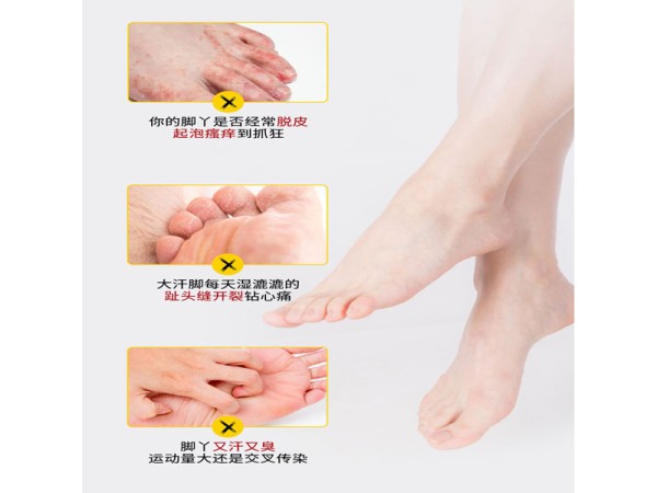 腳氣膏代加工 爛腳丫止癢抑菌去腳臭腳氣 腳部護理產(chǎn)品廠家貼牌定制